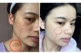 Bạn có muốn nám, tàn nhang vĩnh viễn biến mất không? Điều này hoàn toàn có thể!