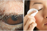 Rận bám đầy mi mắt người phụ nữ: Bác sĩ chỉ điểm lỗi lớn do chị em tự hại mình hằng ngày