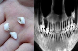 Cô gái 28 tuổi đau đớn vì HAI HÀM RĂNG RỤNG HẾT vì thói quen xấu ai cũng mắc phải mỗi ngày