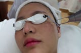Những nguyên tắc sống còn khi trị nám bằng laser mà ai cũng phải 'khắc cốt ghi tâm'