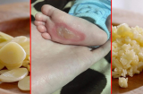 Tỏi rất tốt cho sức khỏe nhưng dùng tỏi chữa bệnh theo cách này lại biến chúng thành chất độc, hậu quả đáng tiếc