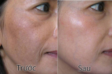 Trị tàn nhang hiệu quả ngay tại nhà với nguyên liệu chưa đến 10.000 đồng