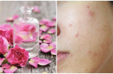 Những sai lầm khi dùng nước hoa hồng khiến hội chị em phải 'khóc thét' vì mặt đầy mụn