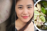 Tẩy trang, xông hơi “chanh sả” - bí kíp loại bỏ mụn ẩn trong chớp mắt