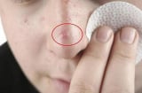 Mụn sưng to, đỏ au như ong đốt cũng “xẹp” nhanh chóng với 6 cách trị mụn tại nhà