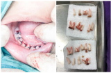 Lặp đi lặp lại thói quen tai hại này khiến bé 4 tuổi mất 18 chiếc răng, đọc để không làm hại con yêu