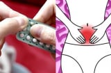 Phụ nữ cần bỏ ngay những thói quen này kẻo vô sinh hiếm muộn, chạy chữa khắp nơi cũng không khỏi