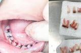 Cảnh báo sau vụ: Cậu bé 4t mất đi toàn bộ 18 chiếc răng vì thói quen lặp đi lặp lại của bố mẹ