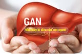 6 thực phẩm ĂN THÌ NGON mà khiến GAN phải làm việc 'quá sức' mà SINH BỆNH, nhiễm mỡ, nguy cơ ung thư