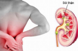 Sỏi thận ai cũng dễ mắc phải: NẮM NGAY 8 THÓI QUEN ngăn ngừa nguy cơ sỏi thận từ sớm, KHÔNG TỐN 1 XU