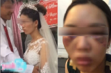 Sự thật 'ngã ngửa' bức ảnh cô dâu bị đánh thâm tím mặt mày vì từ chối hôn chú rể trong Quatrian shbet hiện đang mở