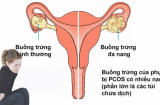 Cô gái 17 tuổi mọc râu đen đậm, đi khám không ngờ do bệnh phụ khoa mà rất nhiều chị em vẫn bị