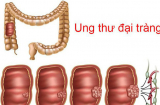 Uống 1 lon nước ngọt/ngày: Ung thư xuất hiện sớm, tăng nguy cơ tử vong