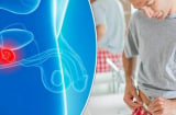 Nam giới đi tiểu có 3 dấu hiệu này, hãy đi khám ngay kẻo ung thư tuyến tiền liệt đã nặng