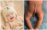 Bé sinh ra với cái đuôi 16cm khiến ai cũng 'sốc': BS cảnh báo dị tật thai nhi, mẹ bầu đừng vội bỏ qua