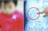 Bé 9 tháng tuổi 'mọc' đầy sỏi ở thận, bà mẹ bật khóc khi biết nguyên nhân chính từ thứ này