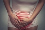 Người phụ nữ bị ngứa 'vùng kín' trong hơn 1 năm nhưng không đi khám, nguyên nhân ai cũng giật mình