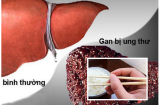 Cảnh báo từ vụ: 2 vợ chồng ăn uống lành mạnh nhưng vẫn ch.ết vì ung thư gan, lý do ai cũng giật mình