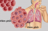 Gặp 6 dấu hiệu này hãy nghĩ ngay tới phổi đang hư hỏng nặng, hãy nhanh chân đi gặp bác sĩ ngay còn kịp