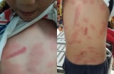 Xôn xao bé trai bị cô ruột nhẫn tâm dùng khúc cây đánh đập thương tích khắp người