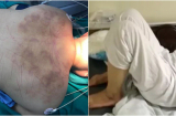 Người phụ nữ mất khả năng vận động sau khi cho thầy lang nắn bóp liên tục 6 tiếng, căn bệnh chớ coi thường