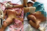 Cô giáo mầm non dùng cồn dạy trẻ kỹ năng phòng chống cháy nổ khiến 3 bé bị bỏng nặng