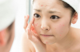 Nổi mụn ở vị trí cực kỳ nguy hiểm này là gan thận có vấn đề nghiêm trọng, cần đi khám gấp