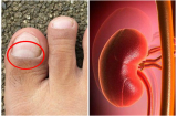 Thấy bàn chân có 'điềm báo' này, hãy cảnh giác vì thận đang gửi lời báo động nhiễm độc nặng