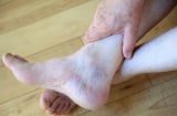Bàn chân có dấu hiệu này hãy cảnh giác với ung thư gan