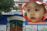 Bé gái 14 tháng tuổi thâm tím mặt sau buổi học đầu tiên: Thông tin chính thức từ công an