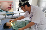 Bé trai 2 tuổi bị bỏng nặng vì mẹ nhỏ nhầm axit để rửa mũi