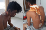 Em trai bị chị ruột đổ nước sôi lên đầu gây bỏng nặng