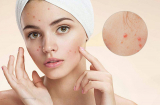 Các thực phẩm gây mụn trứng cá bạn gái nên tránh xa, nhất là trong những ngày lễ Tết