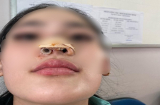 Chi tiền đi làm đẹp, cô gái 16 tuổi bị nhiễm trùng, biến dạng phần đầu mũi