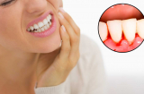 Chảy máu chân răng là lời cảnh báo bạn đang đối diện với căn bệnh nguy hiểm, chớ coi thường