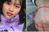 Câu chuyện xúc động về bàn tay rớm máu của nữ y tá Vũ Hán: Đừng cười nhạo sự hy sinh của người khác