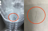 Ăn cháo mua ngoài hàng, bé 13 tháng tuổi bị hóc sợi thép dài 2cm trong cổ họng