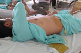 Mâu thuẫn lúc nửa đêm, vợ dùng vật sắc bén cắt 'của quý' của chồng