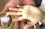 Bé gái 3 tuổi thiếu máu nặng do uống 10 hộp sữa tươi mỗi ngày, bác sĩ cảnh báo sai lầm của phụ huynh