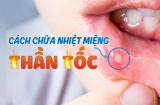 Bị nhiệt miệng cứ thử 1 mẹo đơn giản, hết sưng đau nhanh bất ngờ