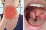 Đối tượng nào dễ bị mắc bệnh bạch hầu?