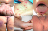 Muốn bảo vệ con thoát bệnh tay chân miệng, cha mẹ nhất định phải biết những điều này