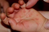 Hết bạch hầu đến bệnh tay chân miệng bùng phát, nhiều trẻ mắc không rõ nguồn lây