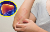 5 biểu hiện chứng tỏ gan đang rất 'nóng', cần thải độc càng sớm càng tốt