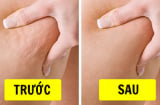 90% phụ nữ bị chứng da sần vỏ cam, chuyên gia 'mách nước' điều trị hiệu quả