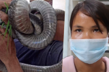 Diễn biến sức khỏe của người đàn ông bị rắn hổ mang cắn: Vết thương hoại tử, lọc máu liên tục