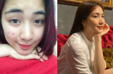 Từng phải cầu cứu dân mạng cách trị mụn, Hòa Minzy chẳng ngần ngại khoe nhan sắc qua camera thường