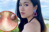 Lâm Vỹ Dạ chính thức lên tiếng giải thích về hình ảnh lưng trần rướm máu, hóa ra thủ phạm là căn bệnh này