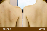 Trị sạch mụn lưng trong vòng '1 nốt nhạc' với bột đậu đỏ