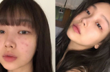 Nàng nào dễ nổi mụn cần thay đổi gấp 6 sai lầm này nếu không muốn da 'toang' hơn nữa